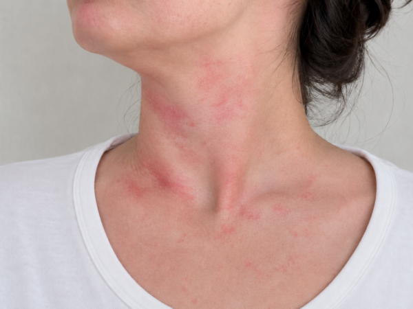 Paciente con lesiones cutáneas compatibles con mastocitosis en la piel.