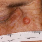 Carcinoma basocelular nodular en el rostro: lesión perlada con vasos sanguíneos visibles