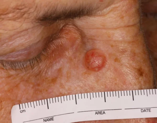 Carcinoma basocelular nodular en el rostro: lesión perlada con vasos sanguíneos visibles